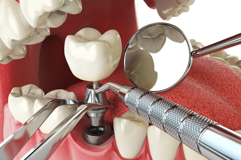 dental implant graphic