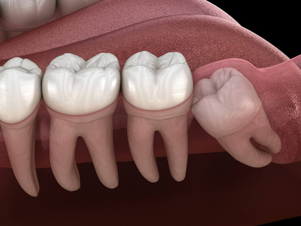 graphic of an impacted tooth