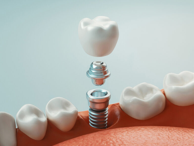 A cross-section image of a jaw highlights a dental implant procedure. It shows the implant screw embedded into the jawbone, the abutment connecting the screw, and the crown attached above it.