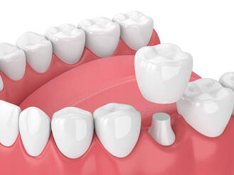 Close‑up dental model showing prepared tooth abutment with separate crown positioned above, surrounded by intact teeth.